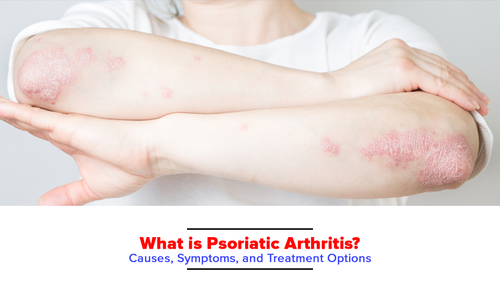 What is Psoriatic Arthritis? Treatment, Symptoms, Causes