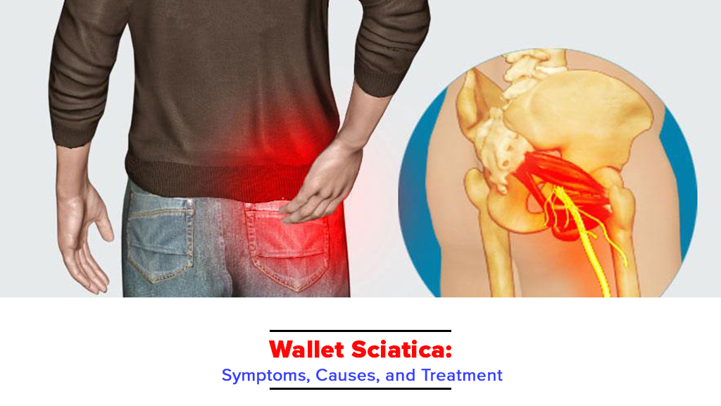 Wallet Sciatica: Symptoms, Causes, and Treatment