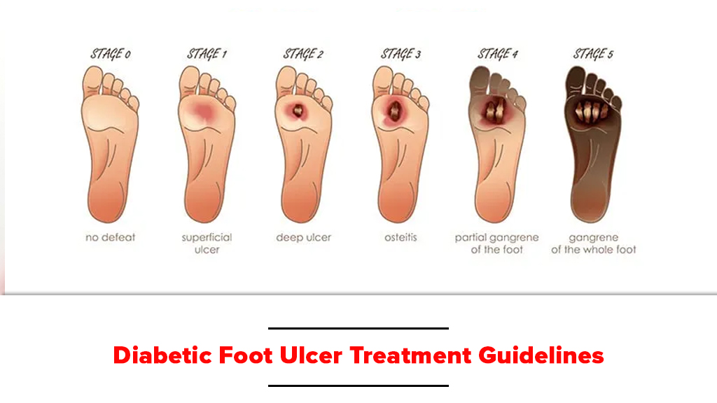 Diabetic Foot Ulcer Treatment Guidelines Bioflex Pakistan 0712